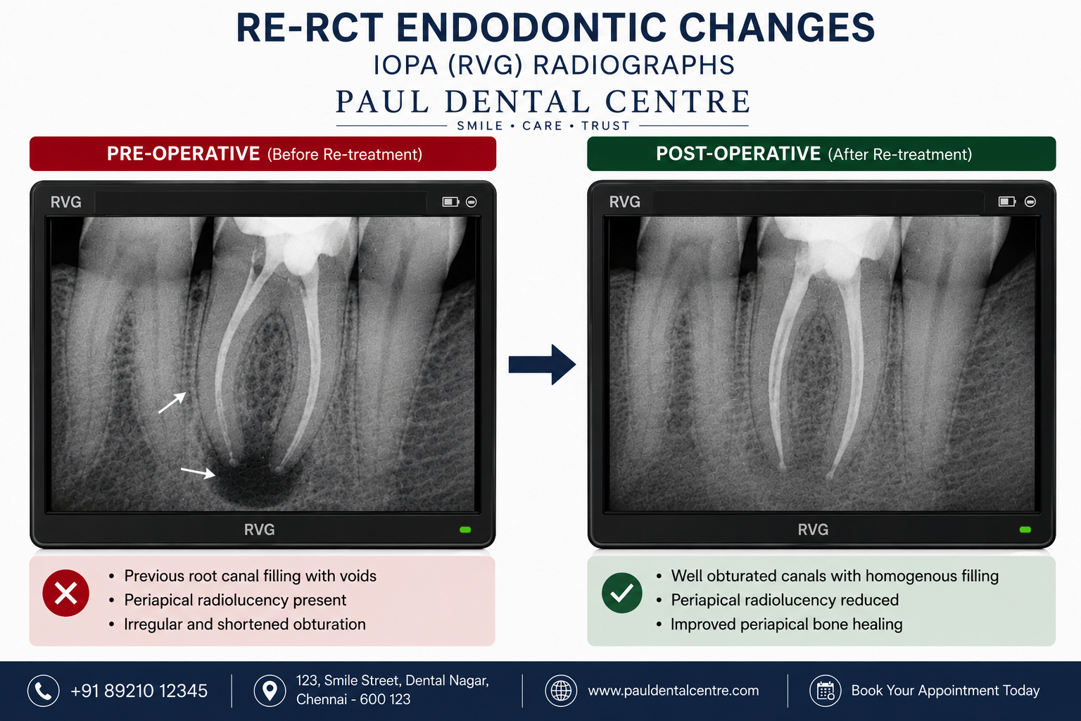 Endodontic Retreatment & Surgery